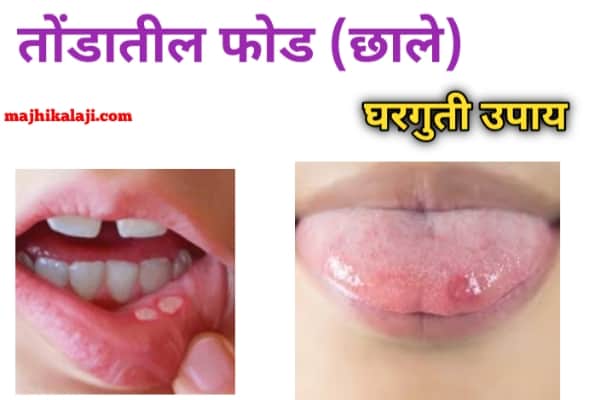 तोंड आल्यावर घरगुती उपाय व जिभेला फोड येणे उपाय | mouth ulcer home remedies in marathi