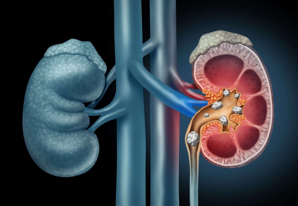 kidney stone home treatment in marathi